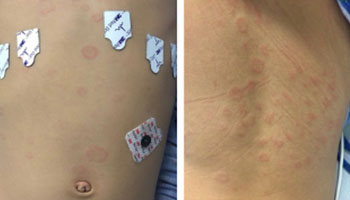 Annular plaques on the torso and back of patients with MIS-C.