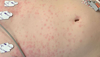 Rash on the torso of a patient with MIS-C.