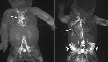 Imaging techniques help treat neonatal lymphatic disorders
