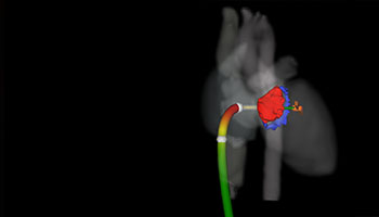 Simulated delivery of transcatheter clip-based therapy in CT image-derived patient specific model.